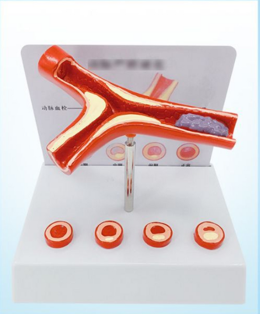 Vascular Anatomy Atheroscosis Teaching Model - Metatron Store