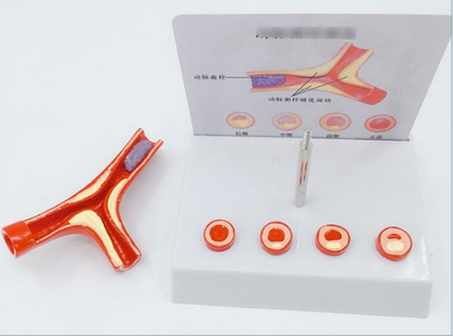 Vascular Anatomy Atheroscosis Teaching Model - Metatron Store