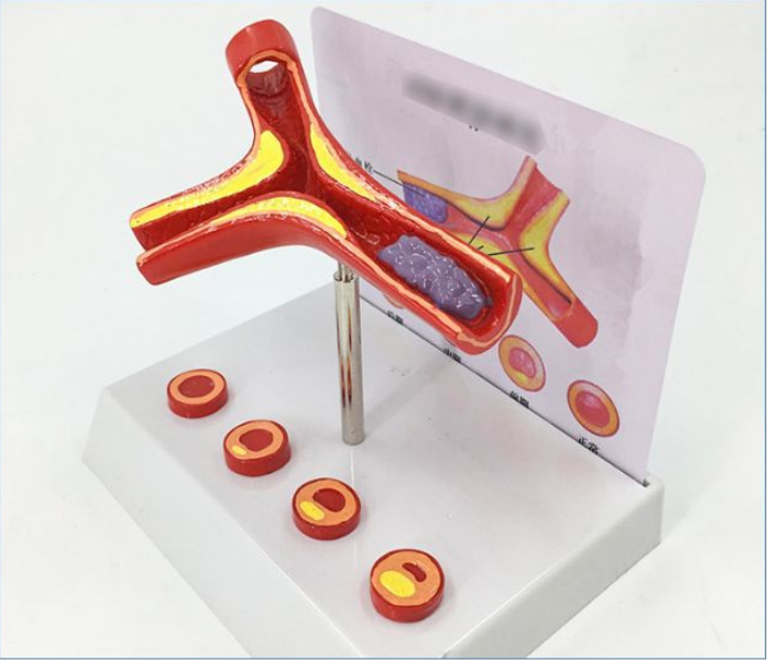 Vascular Anatomy Atheroscosis Teaching Model - Metatron Store