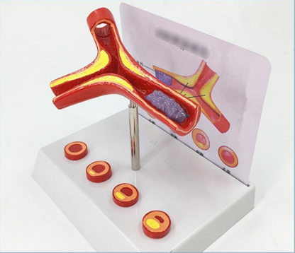 Vascular Anatomy Atheroscosis Teaching Model - Metatron Store
