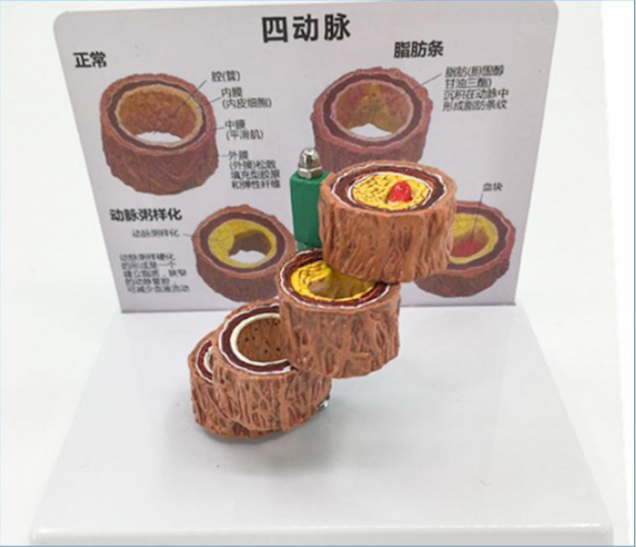 Vascular Anatomy Atheroscosis Teaching Model - Metatron Store
