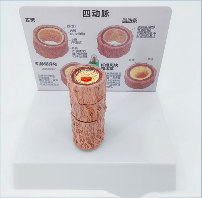 Vascular Anatomy Atheroscosis Teaching Model - Metatron Store