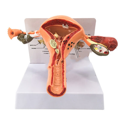 Female Pathological Uterus Model Female Maternal Uterus Structure Anatomy - Metatron Store